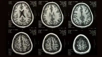 Imagem: https://veja.abril.com.br/saude/cientistas-criam-grafico-com-evolucao-do-cerebro-desde-o-feto-ate-100-anos/