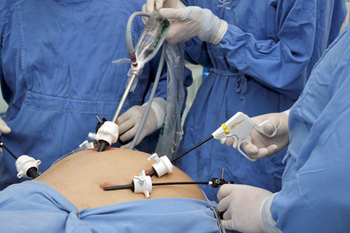 Imagem: https://sbcbm.org.br/a-inovacao-da-cirurgia-laparoscopica/