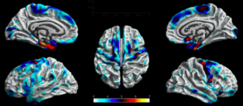 Imagem: https://agencia.fapesp.br/tecnica-de-neuroimagem-ajuda-a-entender-efeitos-da-epilepsia-no-cerebro/27246